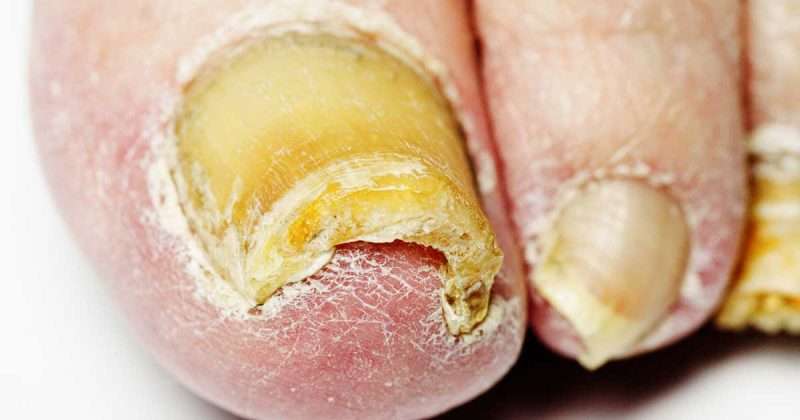 4 Steps To Get Rid of Toenail Fungus Naturally Once and For All