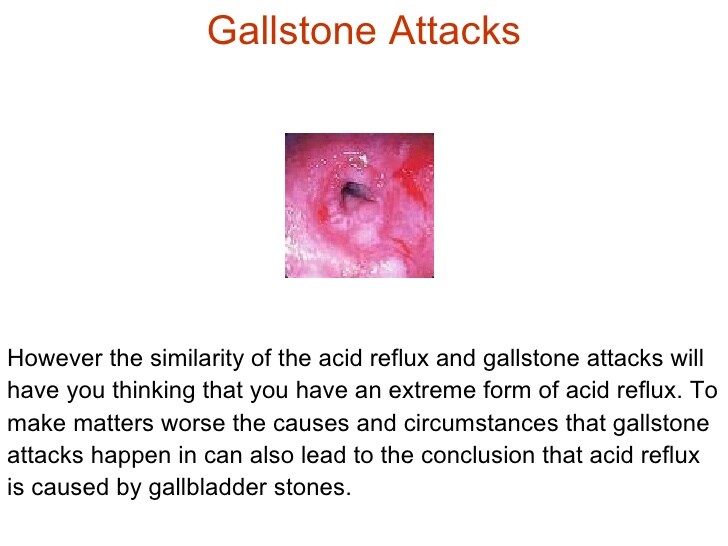 Acid Reflux Caused by Gallbladder Stones: A Misconception