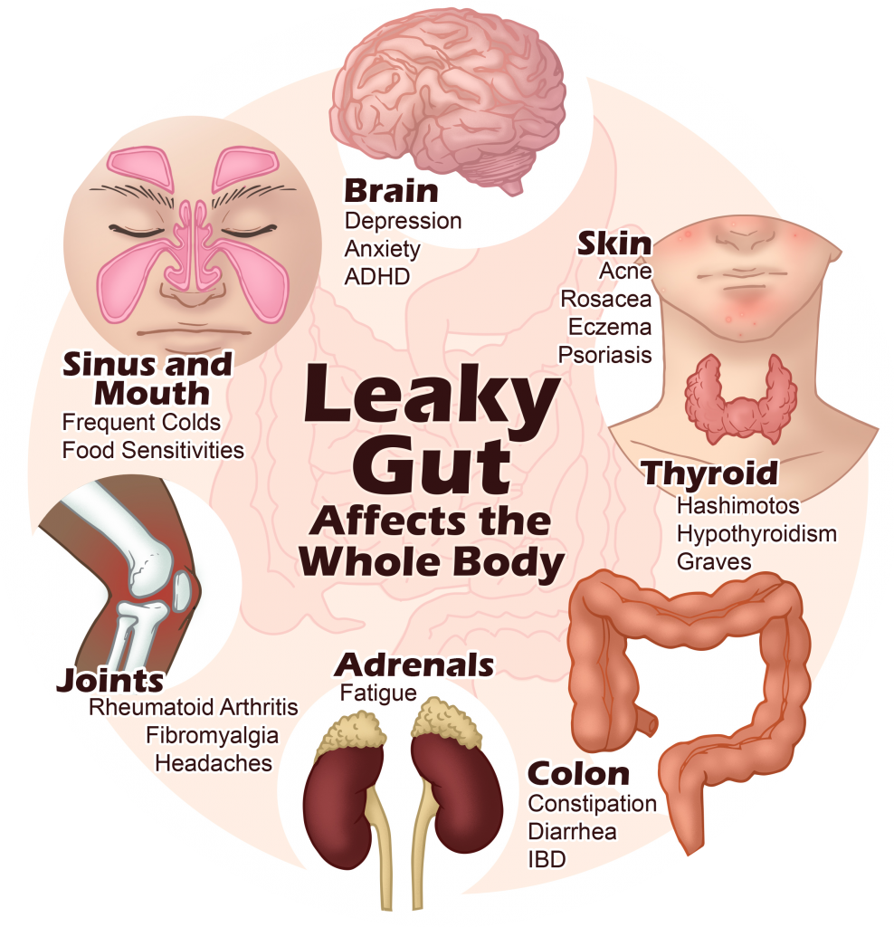 anadesignandrentals: How To Cure Leaky Gut Naturally