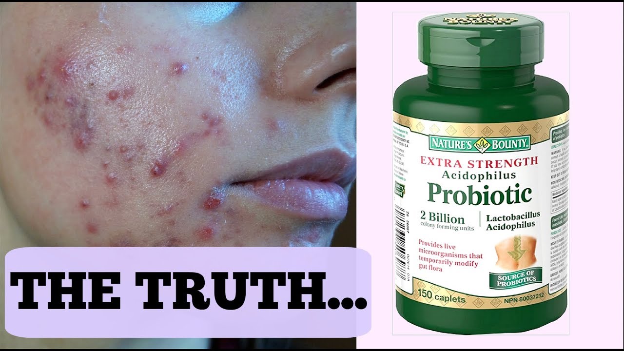 Best Probiotic For Acne