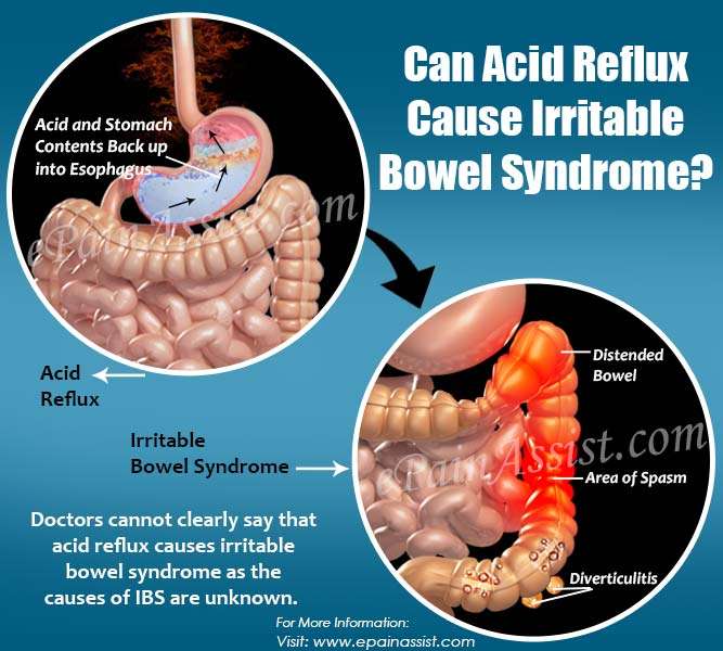Can Acid Reflux Cause Irritable Bowel Syndrome?