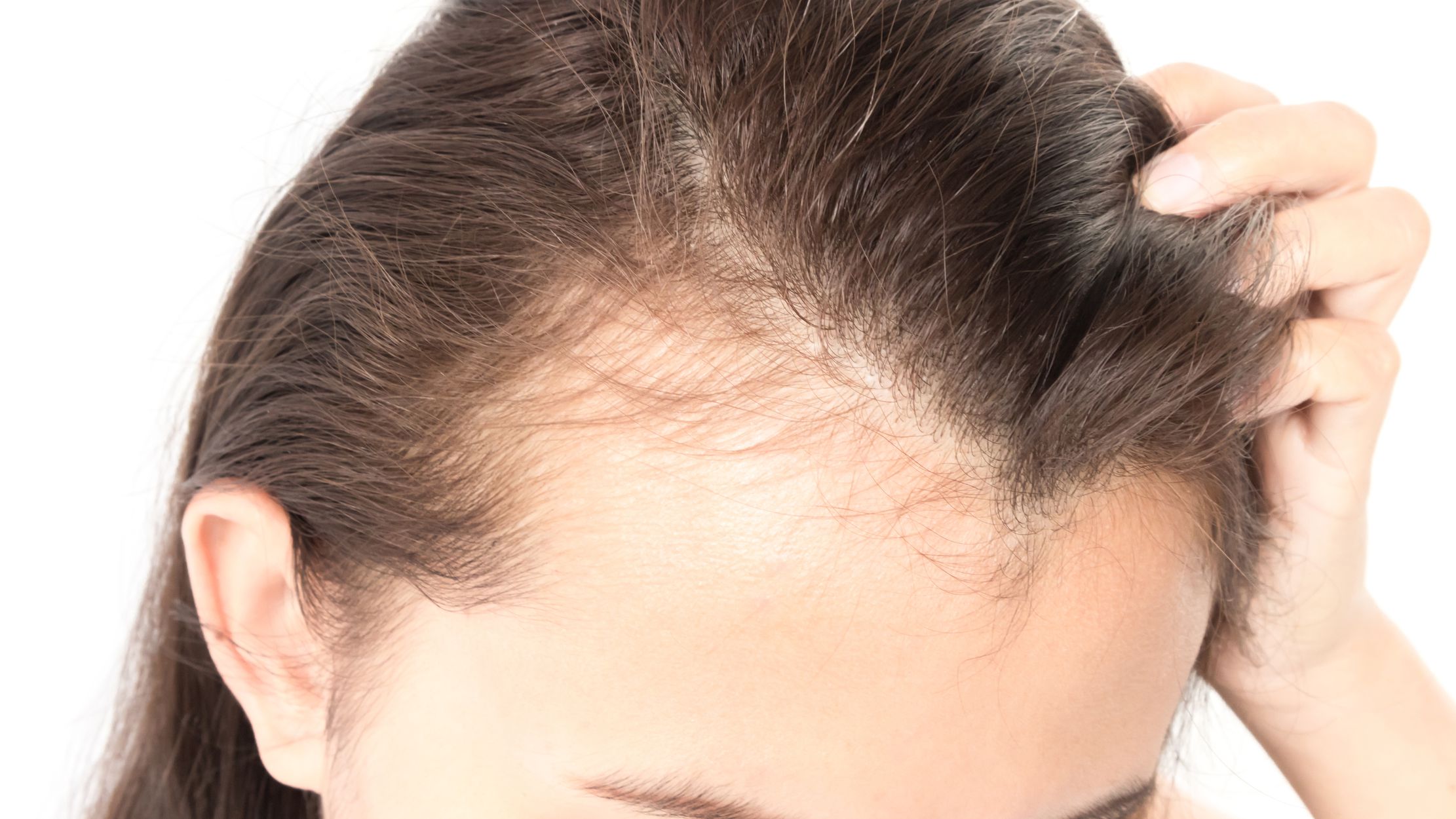 Can Fructose Malabsorption Cause Hair Loss