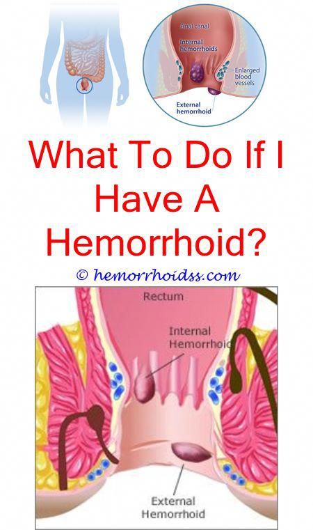 Can You Pop Hemorrhoids At Home? can diarrhea cause ...