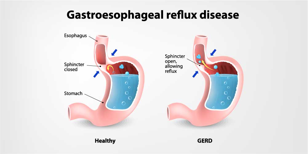 Difference between Hiatal Hernia and GERD
