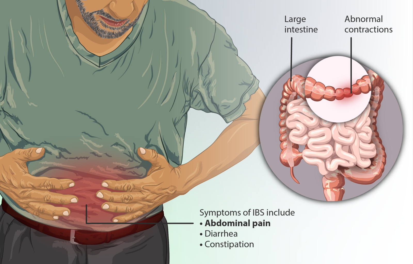 Difference Between Irritable Bowel Syndrome IBS and Ulcerative Colitis ...
