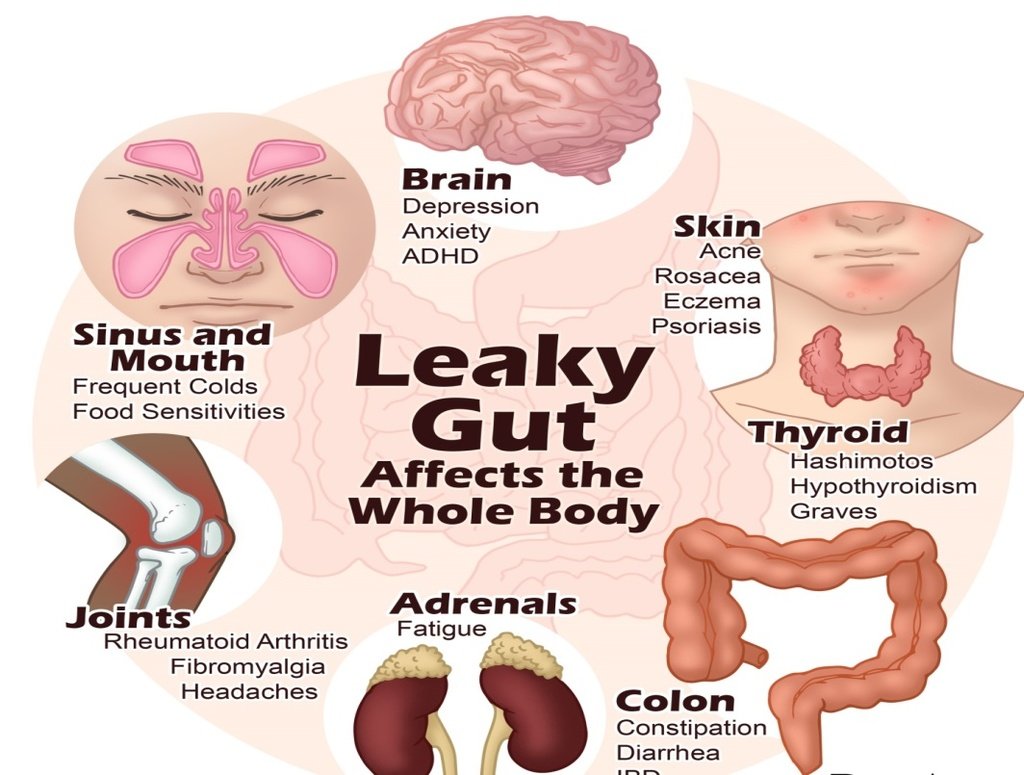 Do you have a leaky gut?