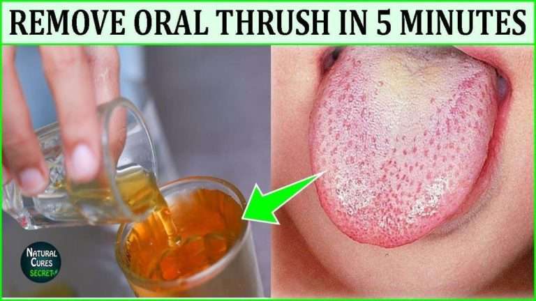 Home Remedies For Thrush In Infants, Be Ahead By Using All These Basic ...