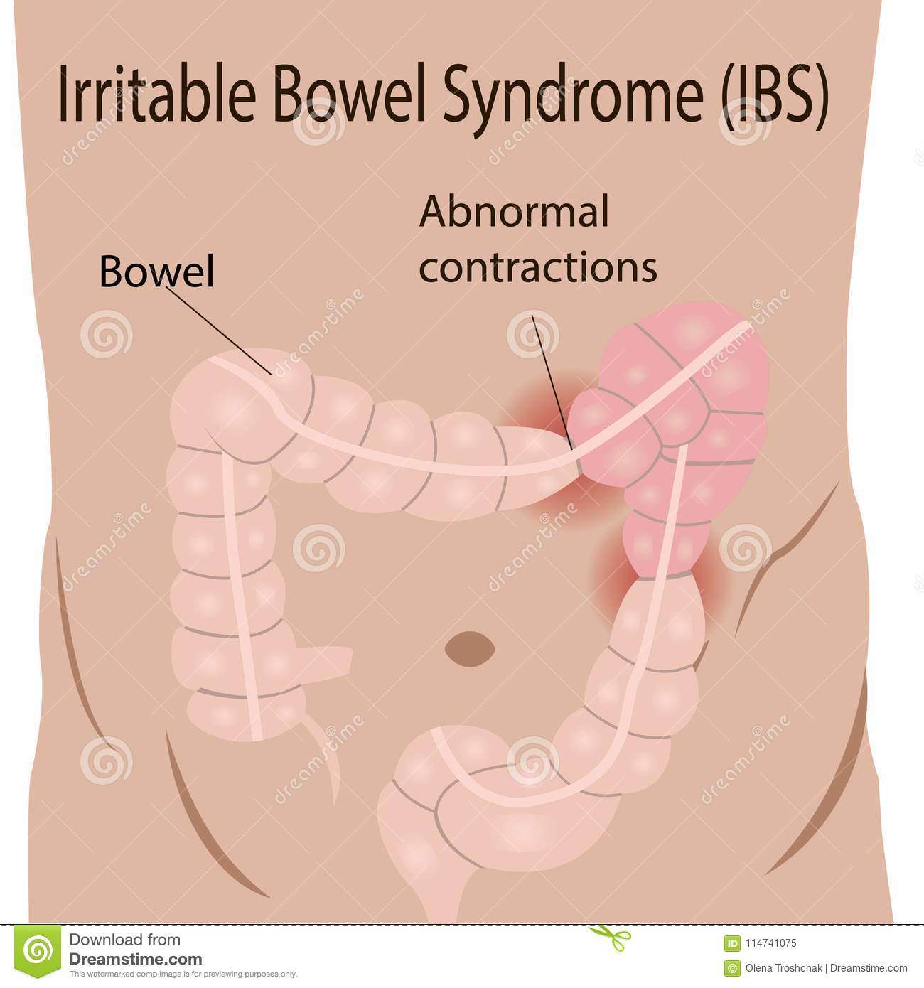 Irritable Bowel Syndrome IBS In A Large Intestine Stock Vector ...