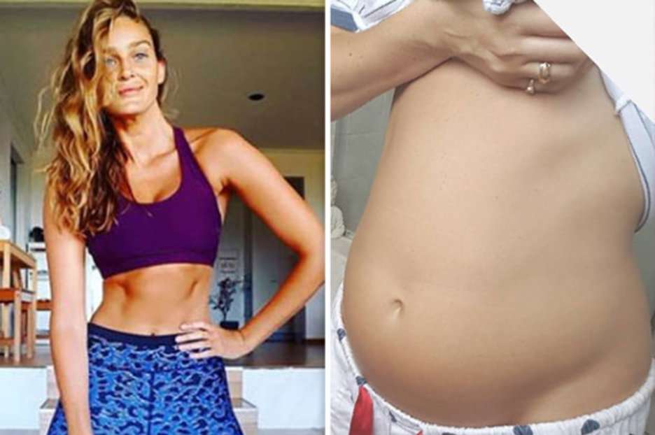 Irritable bowel syndrome: Instagram model Alyce Crawford shares IBS ...