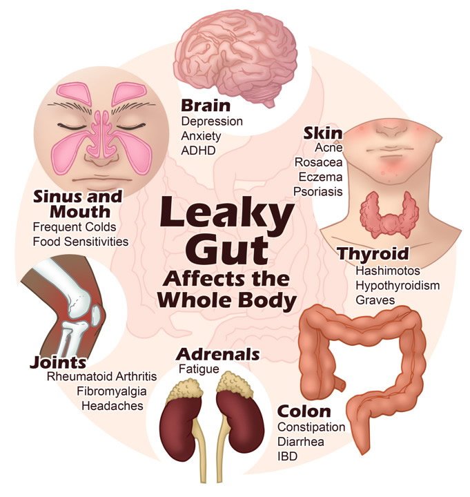 Leaky Gut and Irritable Bowel Syndrome