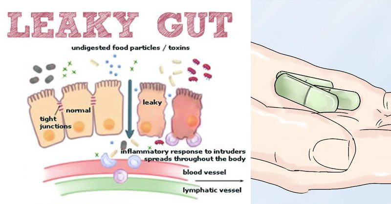 Leaky gut can cause bloating, diarrhea, and serious health ...