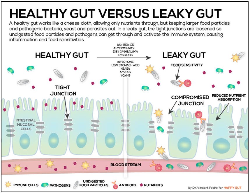 Leaky gut, inflammation, autoimmune diseases, food and ...