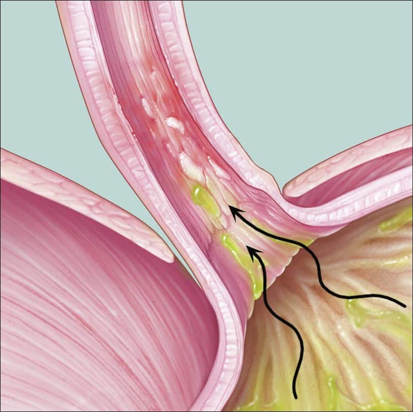 medical illustration of heartburn and GERD
