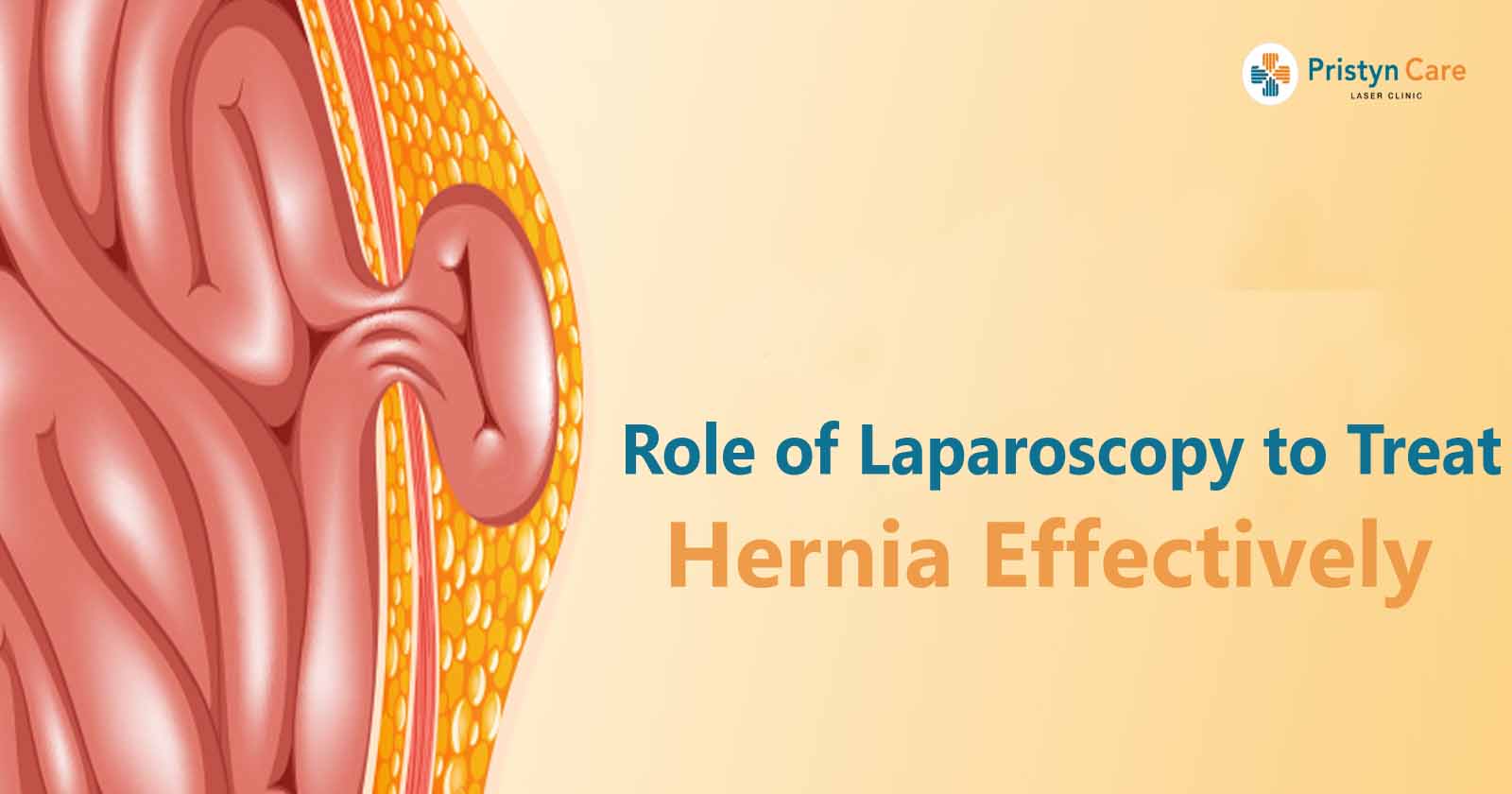 Role of Laparoscopy to Treat Hernia Effectively