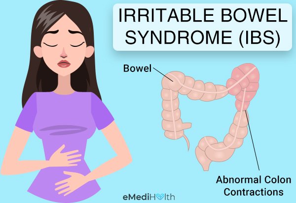 Signs and Symptoms of Irritable Bowel Syndrome (IBS)