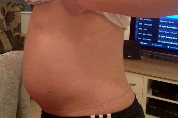 Student who looked eight months pregnant discovered swollen stomach was ...