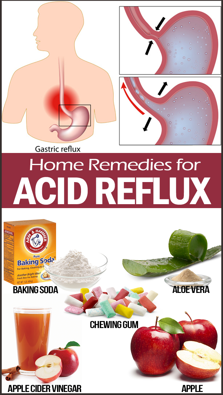 The 25+ best Remedy for acid reflux ideas on Pinterest ...