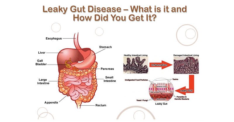 The Facts On Leaky Gut Syndrome, And How To Tell If You ...