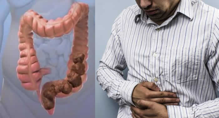 What Causes Constipation? 12 Surprising Reasons You