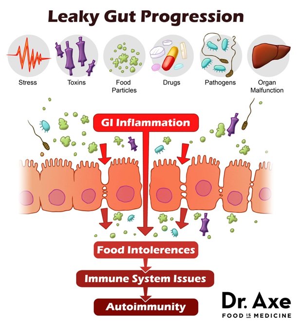 What Exactly Is Leaky Gut And How Do I Start Healing It ...