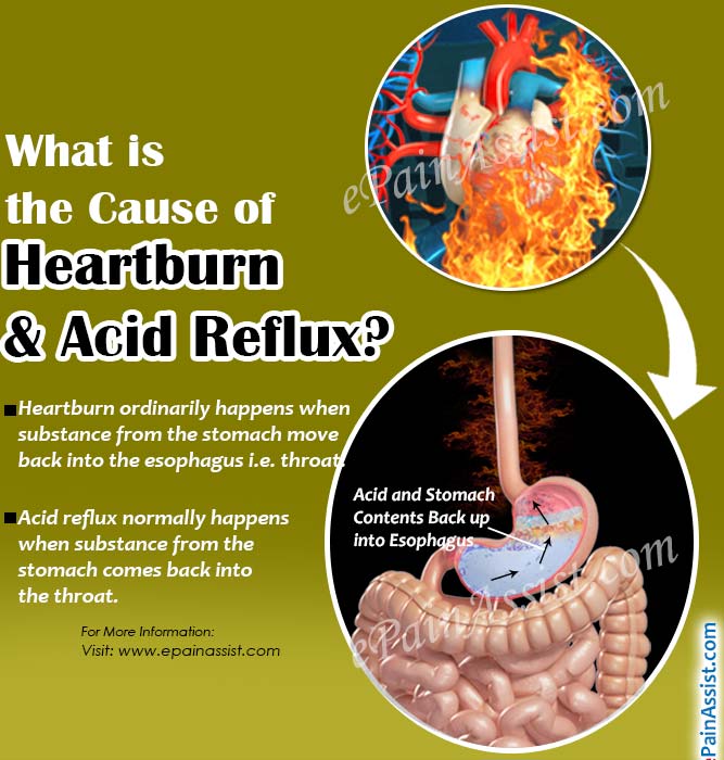 What is the Cause of Heartburn &  Acid Reflux?