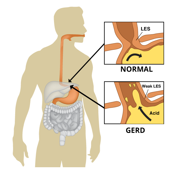 Whats The Difference Between Gerd And Acid Reflux