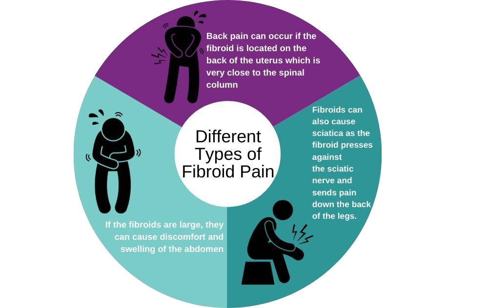 Why Fibroids Cause Leg and Back Pain